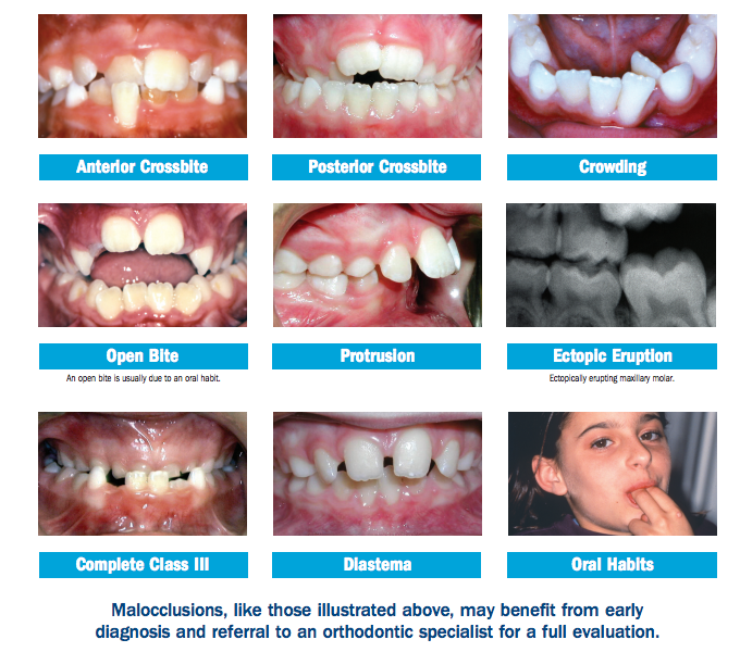 common orthodontic problems in kids