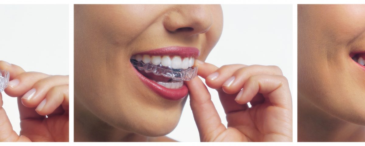 invisalign teeth straightening trays