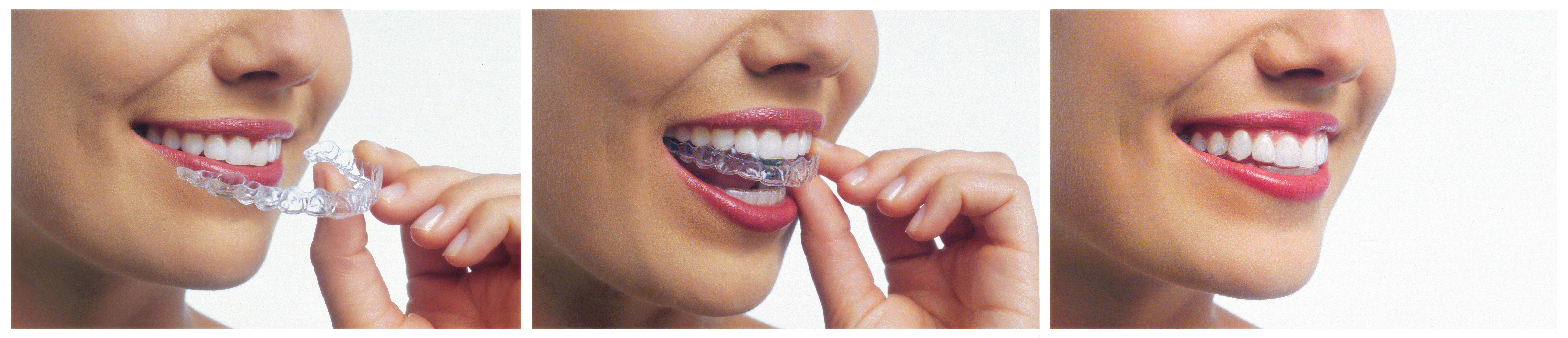 straighten teeth with invisalign for adults and teens