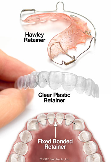 types of retainers