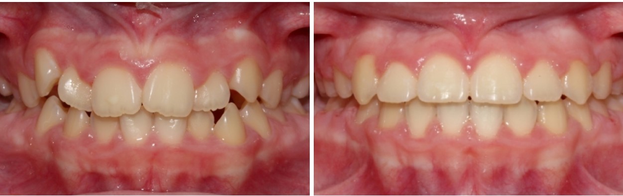 crowding teeth orthodontics prostora zobe pomanjkanje koper ortodontija prej potem